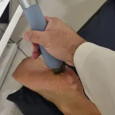 Aplicação de Ondas de Choque no pé para Fascite Plantar