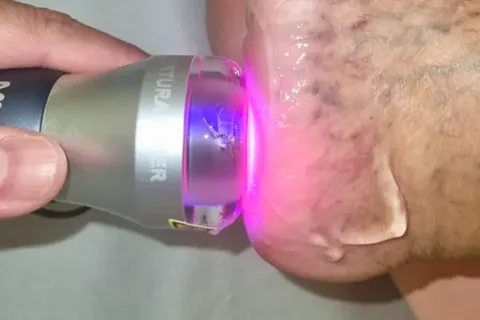 Cabeçote de ondas de choque apoiado na pele durante aplicação para fascite plantar