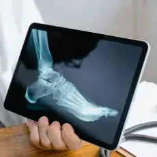 Raio X do pé usado no controle da evolução da fascite plantar